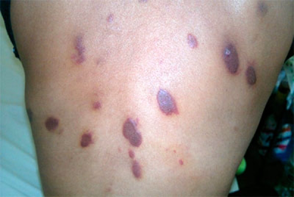 Sarcoma de Kaposi