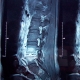 Espondilodiscitis lumbar